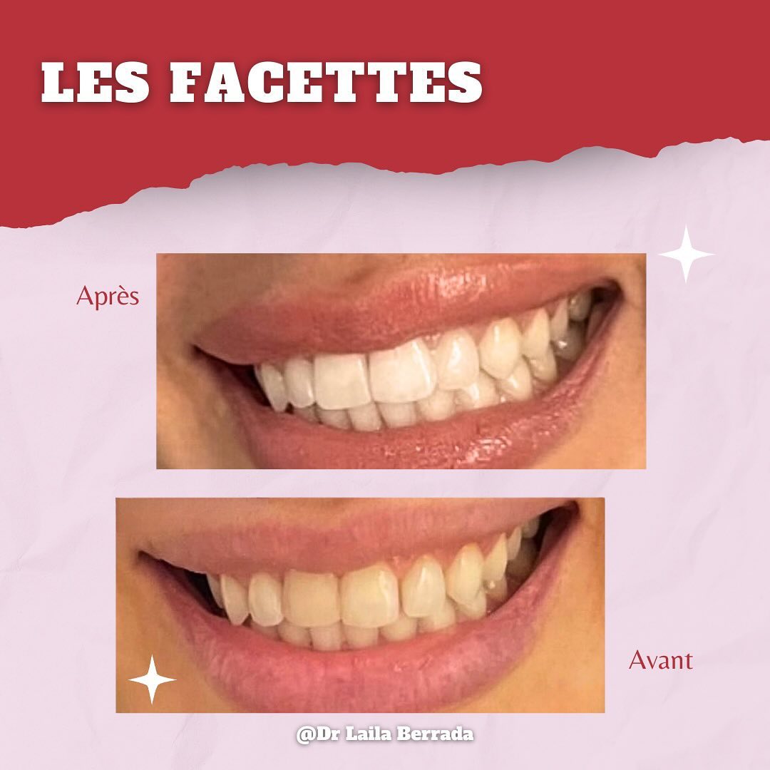 Transformation de sourire - Cas 6
